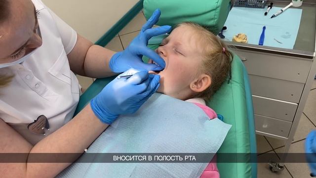 Фиксация аппарата Марко Росса / Исправление прикуса у детей смотреть онлайн