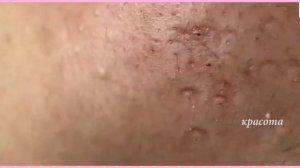 Как Избавиться от Угрей Раз и Навсегда  #05 | угри Сочные жирненькие