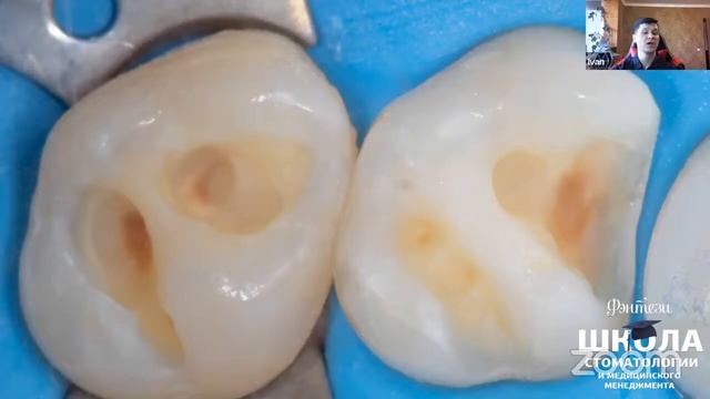 Бесплатный вебинаров "Реставрация на жевательный зубы" от Ивана Казадаев смотреть онлайн