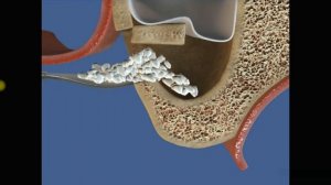 Открытый синус-лифтингОткрытый синус-лифтинг