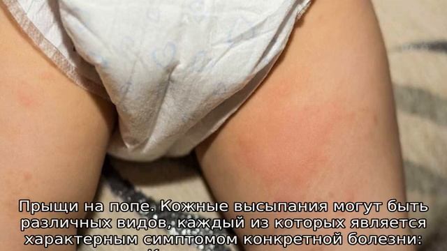 Сыпь на попе у ребенка смотреть онлайн