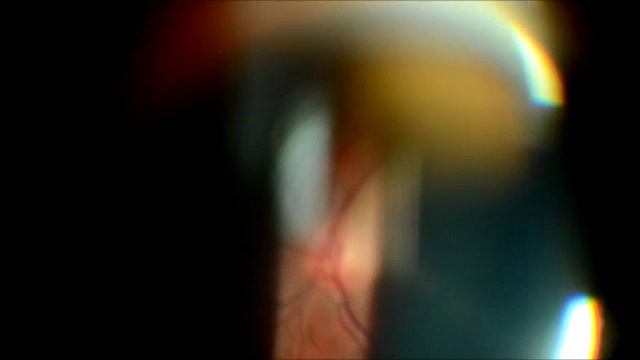 Щелевая лампа ЩЛ-2Б Фотокамера часть 2 смотреть онлайн