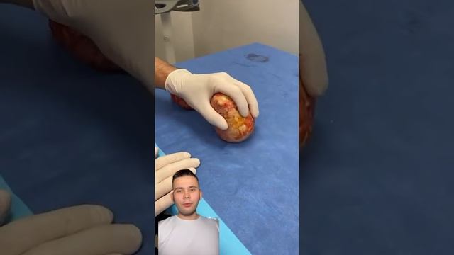 Кальцификация имплантатов смотреть онлайн