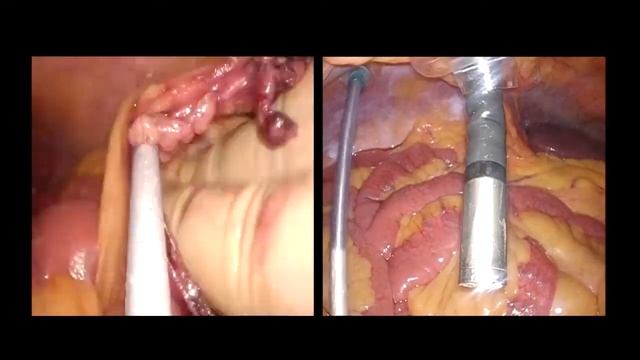 ENDOEYE FLEX Colectomy Surgery – Olympus Surgical смотреть онлайн