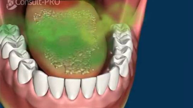Oral Hygiene Instructions Tongue Cleaning And Bad Breath смотреть онлайн