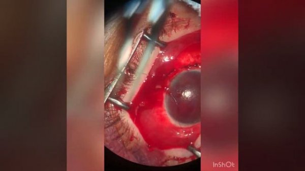 Ушивание склеры