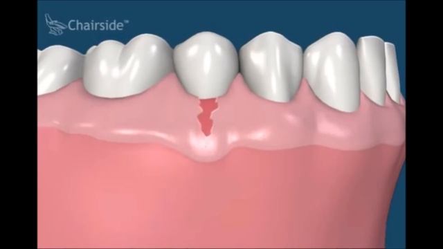 Как лечится рецессия десны. Что делать если оголились корни в зубах Стоматология смотреть онлайн