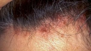 Прыщи на голове