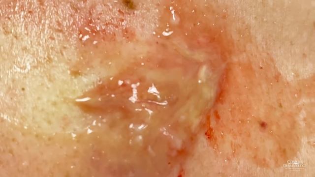 Cyst Removed like Runny Eggs смотреть онлайн