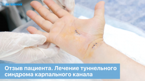 Отзыв пациента. Лечение туннельного синдрома карпального канала (заболевания кисти рук) в ОН КЛИНИК.