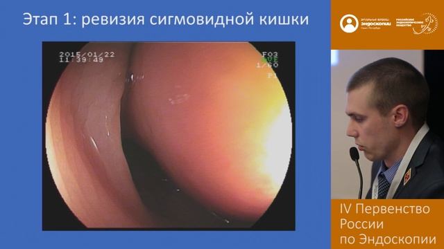 Эндоскопическое удаление крупного подслизистого образования толстой кишки смотреть онлайн