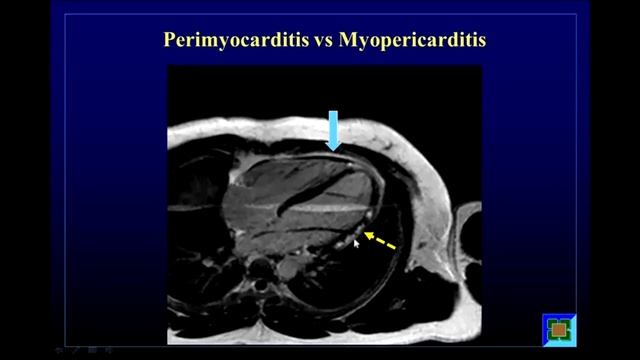 Multimodality Cardiovascular Imaging of Patients with Pericardial Disease смотреть онлайн