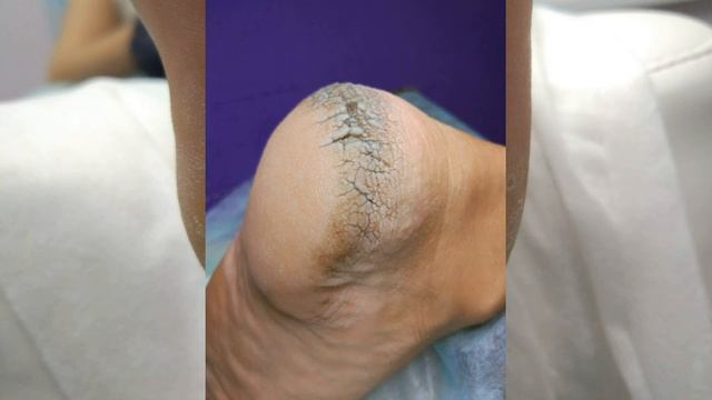 Подология и подолог Нойлингер Оксана