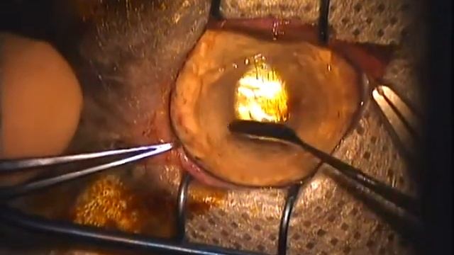 Удаление корнеального секвестра. Замещение дефекта донорской роговицей смотреть онлайн