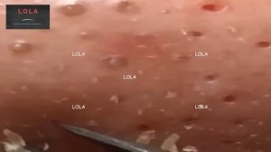 Most Relaxing, Satisfying, Enjoyable; Acne Removal with Tweezer 12 Medley; Stress Reliever