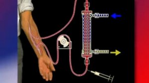 Гемодиализ, принцип, мембрана, подключения