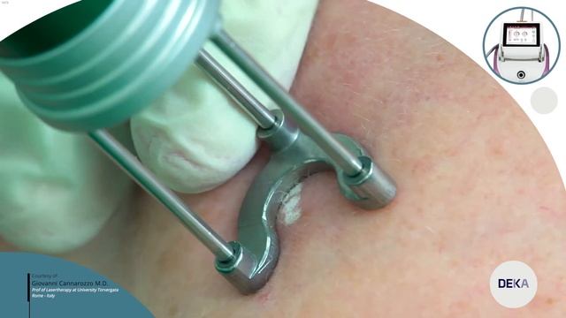 DEKA Luxea - Q Swiched Nd Yag Prisma Benign Pigmented Lesion Treatment смотреть онлайн