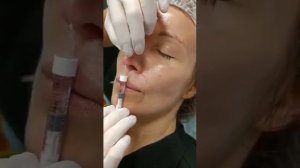 АирисКом студенты учатся: коррекция носа филлером. Семинар для студентов.