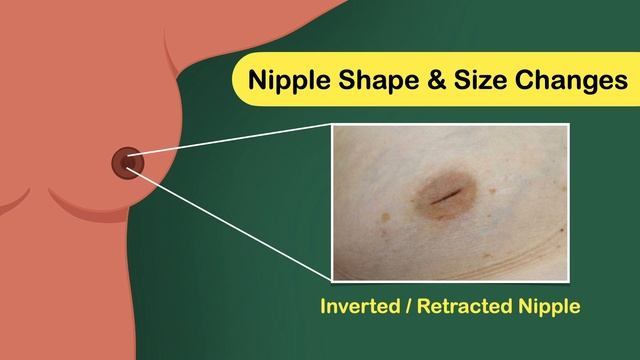 Breast Cancer Symptoms | Early Warning Signs of Breast Cancer | Breast Examination смотреть онлайн