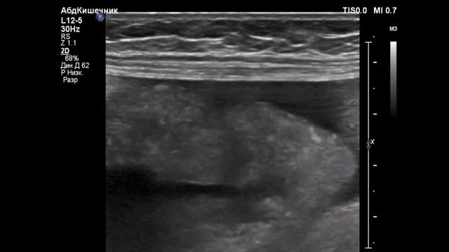 Канцероматоз брыжейки и сальника/Canceromatosis Of The Mesentery And Epiploon