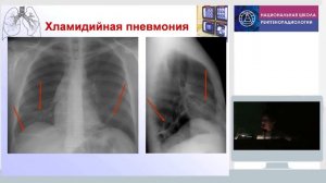 Рентгенодиагностика пневмоний у взрослых