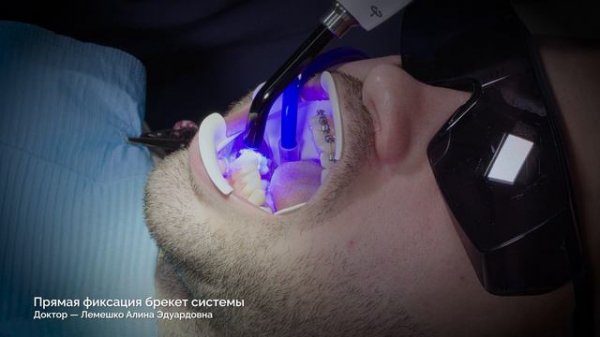 Прямая фиксация брекет системы. Ортодонт в Сочи. Клиника Орто Классика.