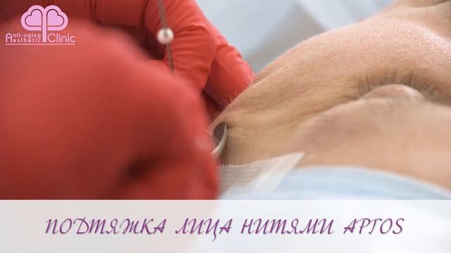 Нитевой лифтинг нитями Aptos Москва. А клиника. смотреть онлайн