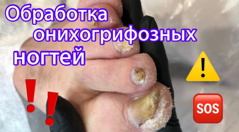 Обработка онихогрифозных ногтей ??⚠️❗️?? смотреть онлайн