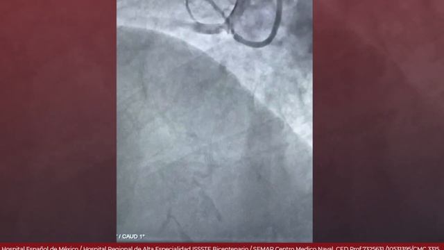 Intervención Coronaria Percutánea - Coronaria Derecha смотреть онлайн
