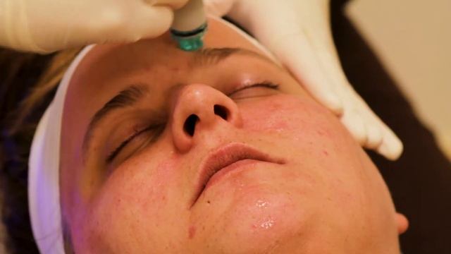 Hydrafacial Procedure
