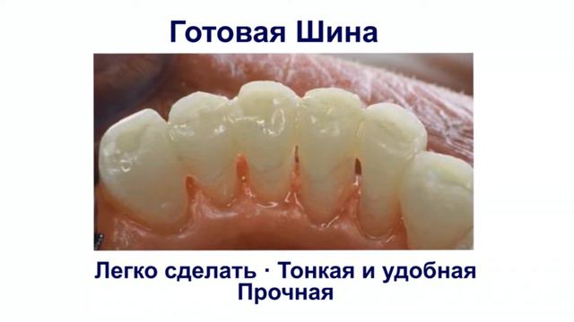 Ribbond Dental Fiber - Russian Captions