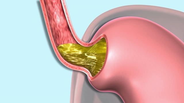 Gastroesophageal Reflux (GERD) смотреть онлайн
