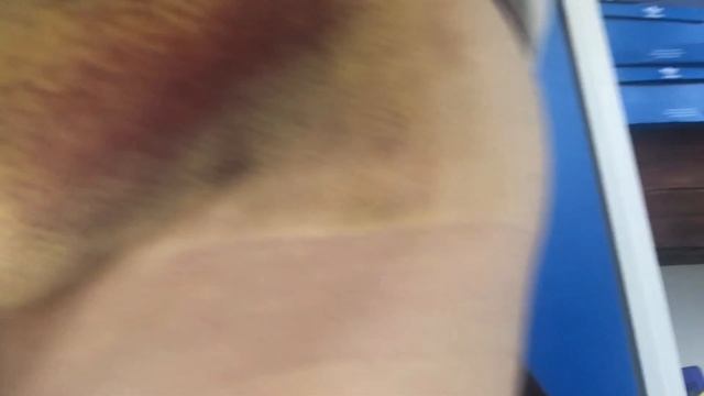 My Cancer Journey - Bruising after Lumpectomy + Lymph Node Biopsy (WHAT TO EXPECT) Week by Week смотреть онлайн