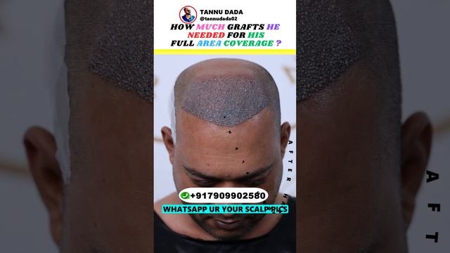 DENSE HAIR TRANSPLANT IS NOW IN THE MARKET #shorts смотреть онлайн