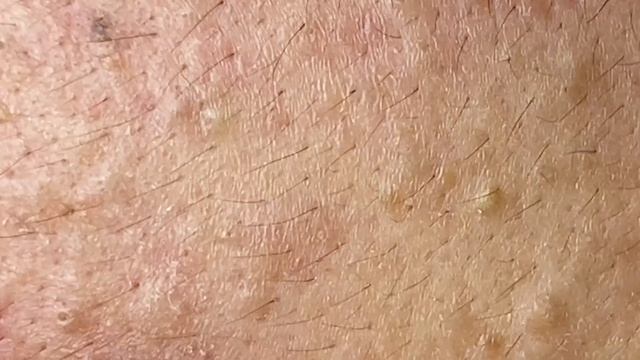 Best Pimple Popping P1 | Mụn Dậy Thì Siêu Hấp Dẫn P1 - SacDepSpa#181 смотреть онлайн