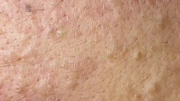 Best Pimple Popping P1 | Mụn Dậy Thì Siêu Hấp Dẫn P1 - SacDepSpa#181