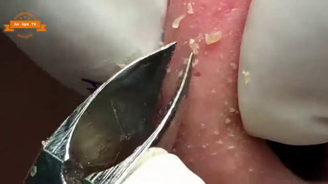 Удаление прыщей с носа и щек Spa #076 смотреть онлайн