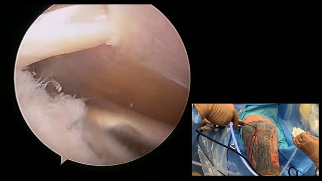 Arthroscopic Bicep Tenodesis