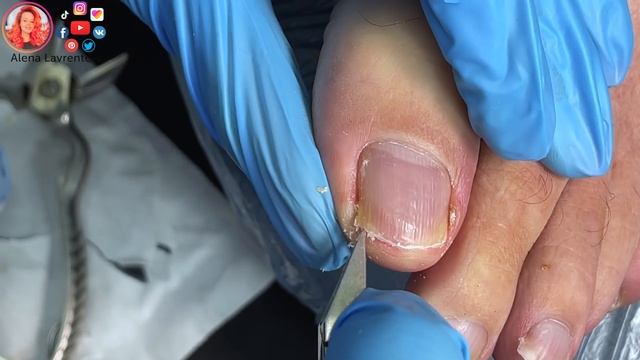 Врастают ногти на ногах / Ноготь склонный к врастанию