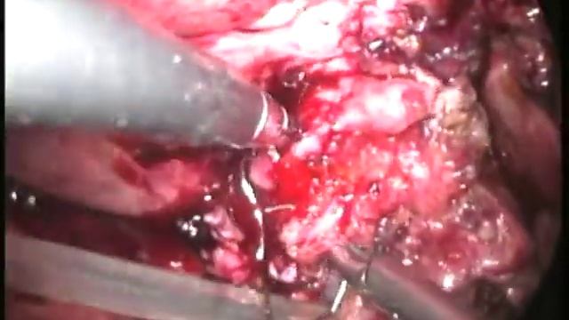 5 холедох смотреть онлайн