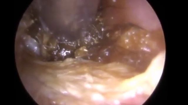 Прокол ушей и уход за ними