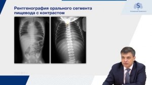 Атрезия пищевода
