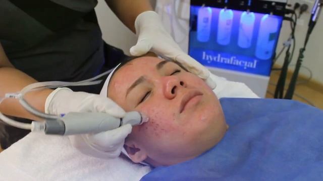 Hydrafacial