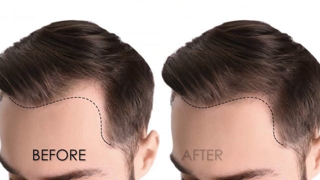 PRP Hair Restoration смотреть онлайн