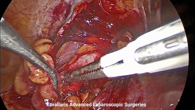 Laparoscopic Sentinel lymph node dissection SLND with ICG Technology in endometrial cancer смотреть онлайн