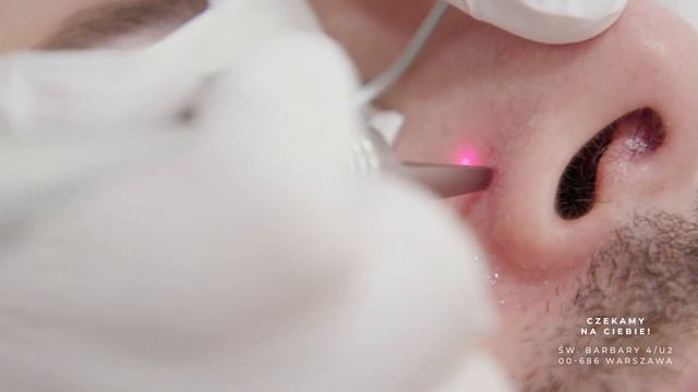Laserowe zamykanie naczynek Quadrostar смотреть онлайн