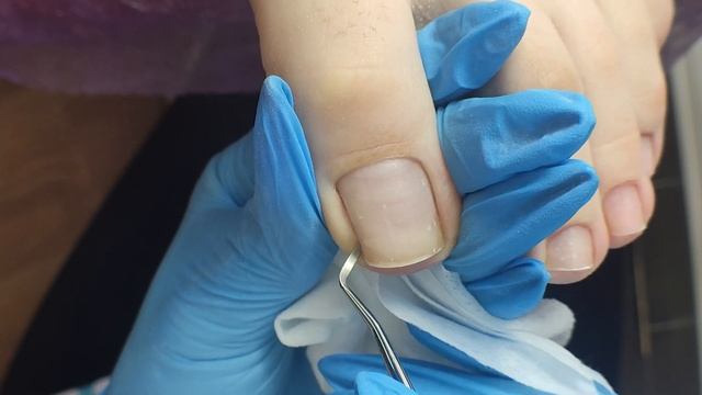 ОГРОМНЫЕ ПОДНОГТЕВЫЕ МОЗОЛИ ПРОПАЛИ? АППАРАТНЫЙ ПЕДИКЮР ПОДРОБНО?Почему болят ногти на ногах? 腳趾甲 смотреть онлайн