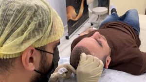 10-й день после пересадки волос!Как выглядит пациент после пересадки волос!!