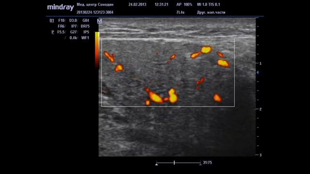 Это норма или нет? Слюнная железа. смотреть онлайн