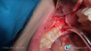Wisdom tooth removal in 5 MIN or less